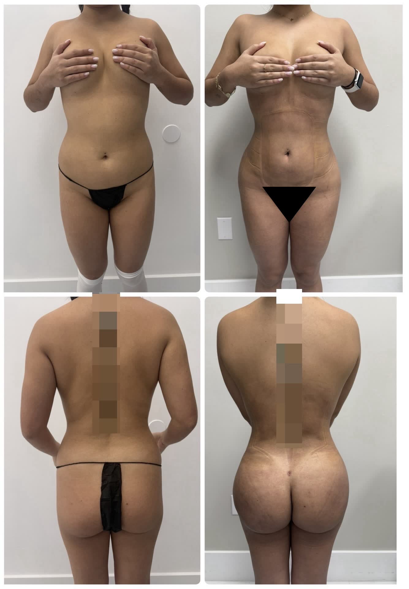 Lipo 360 y BBL — antes y después