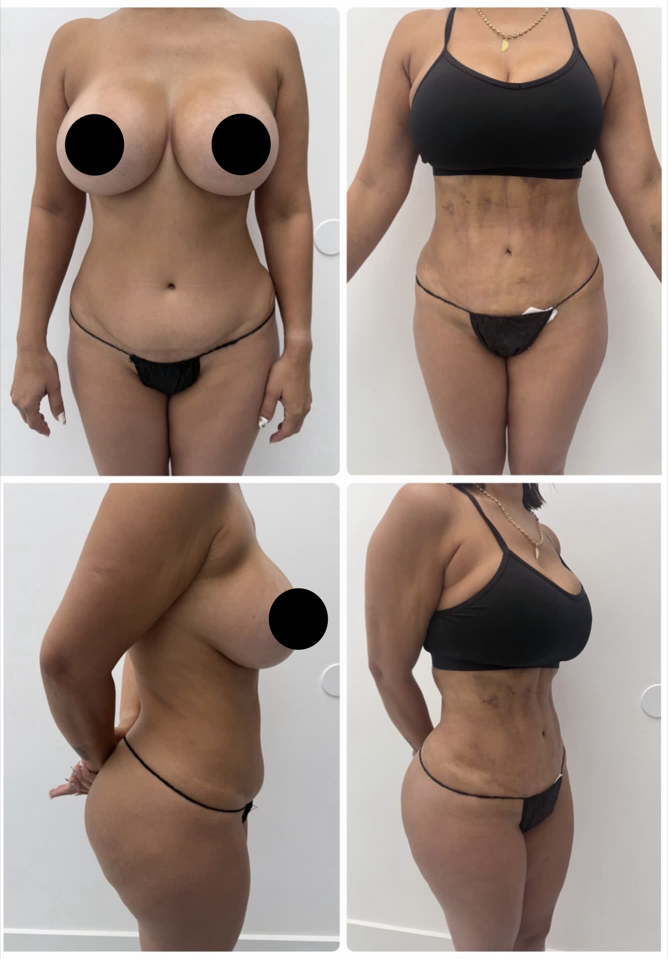 Mommy makeover — antes y después