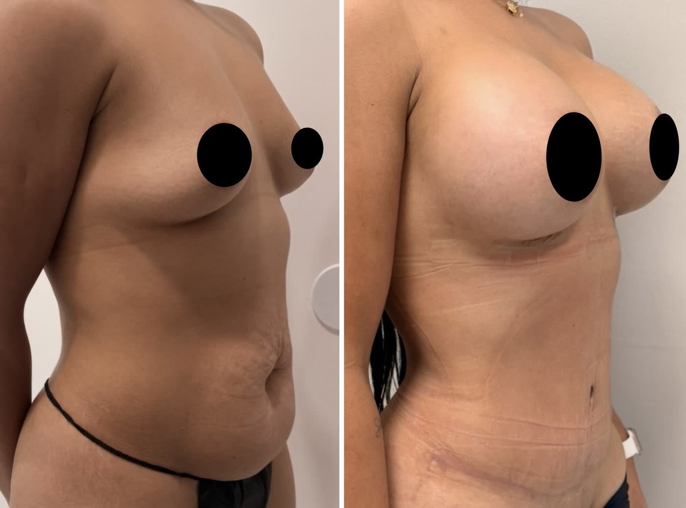 Mommy makeover — antes y después