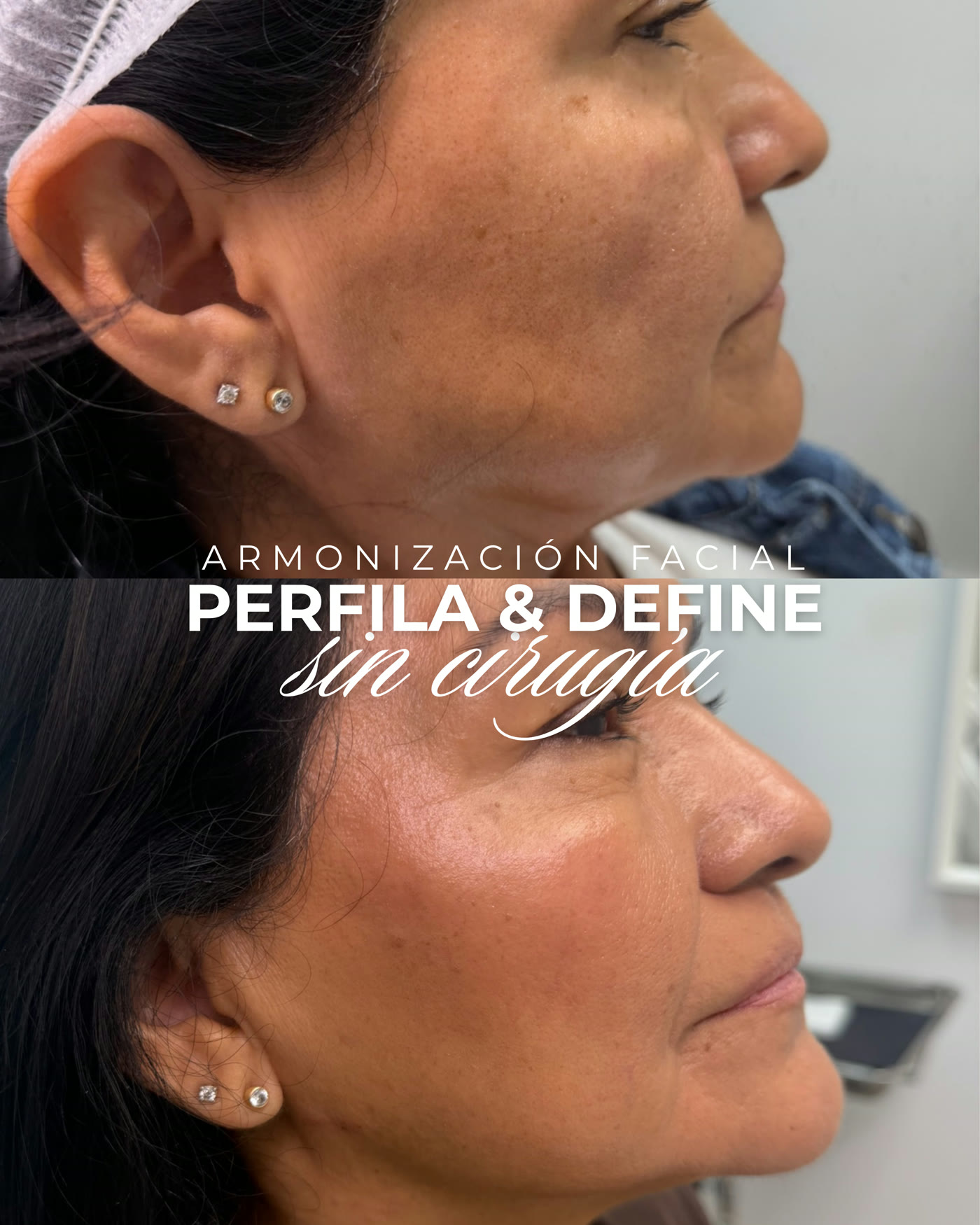 Armonización facial — antes y después
