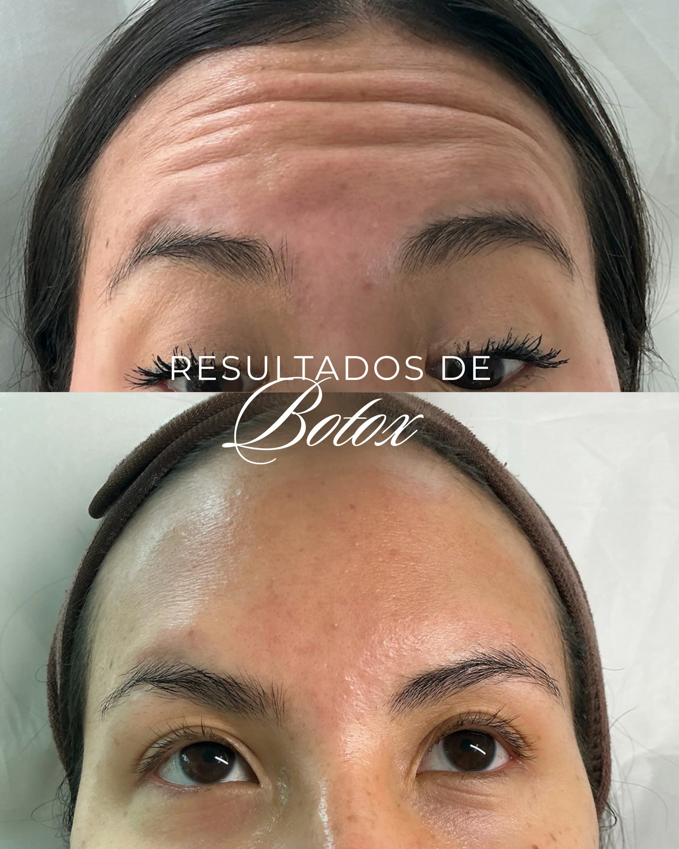 Botox — antes y después