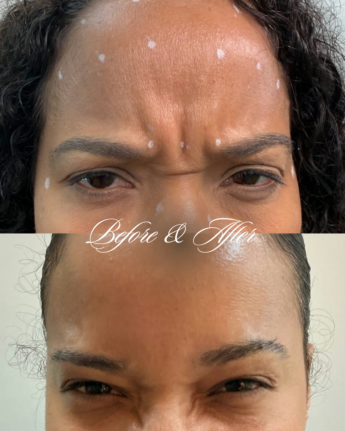 Botox — antes y después