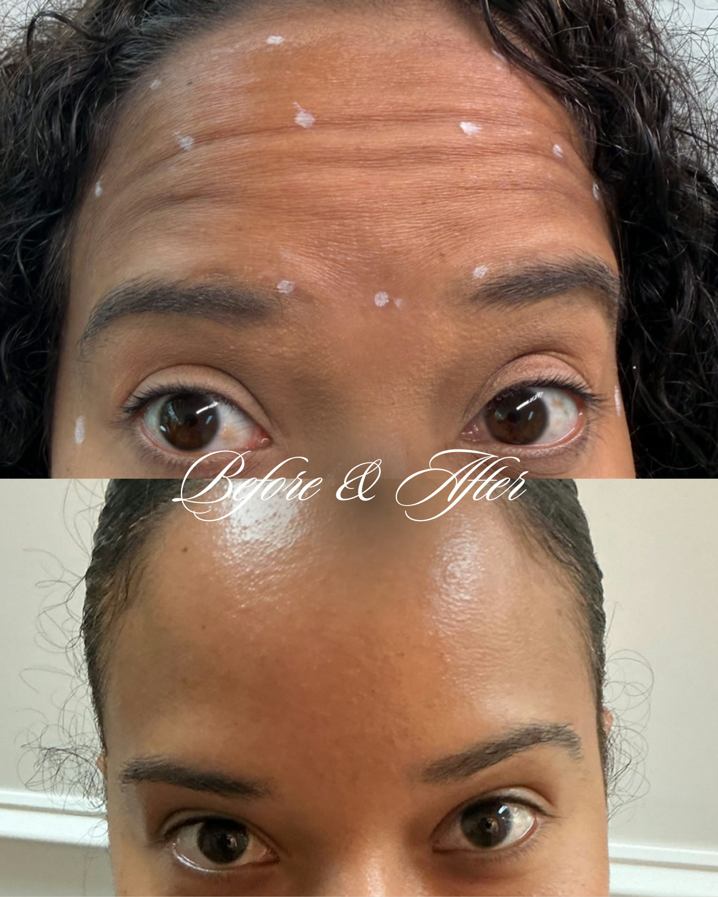 Botox — antes y después