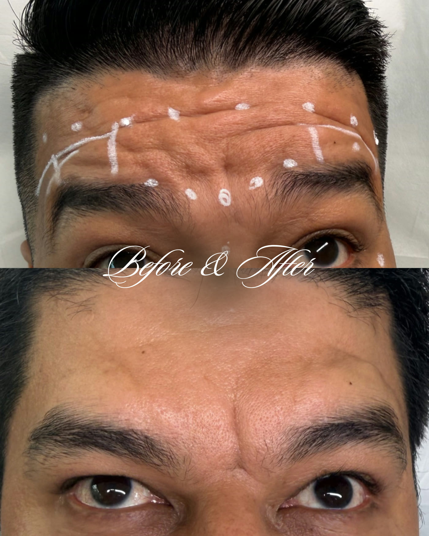 Botox — antes y después