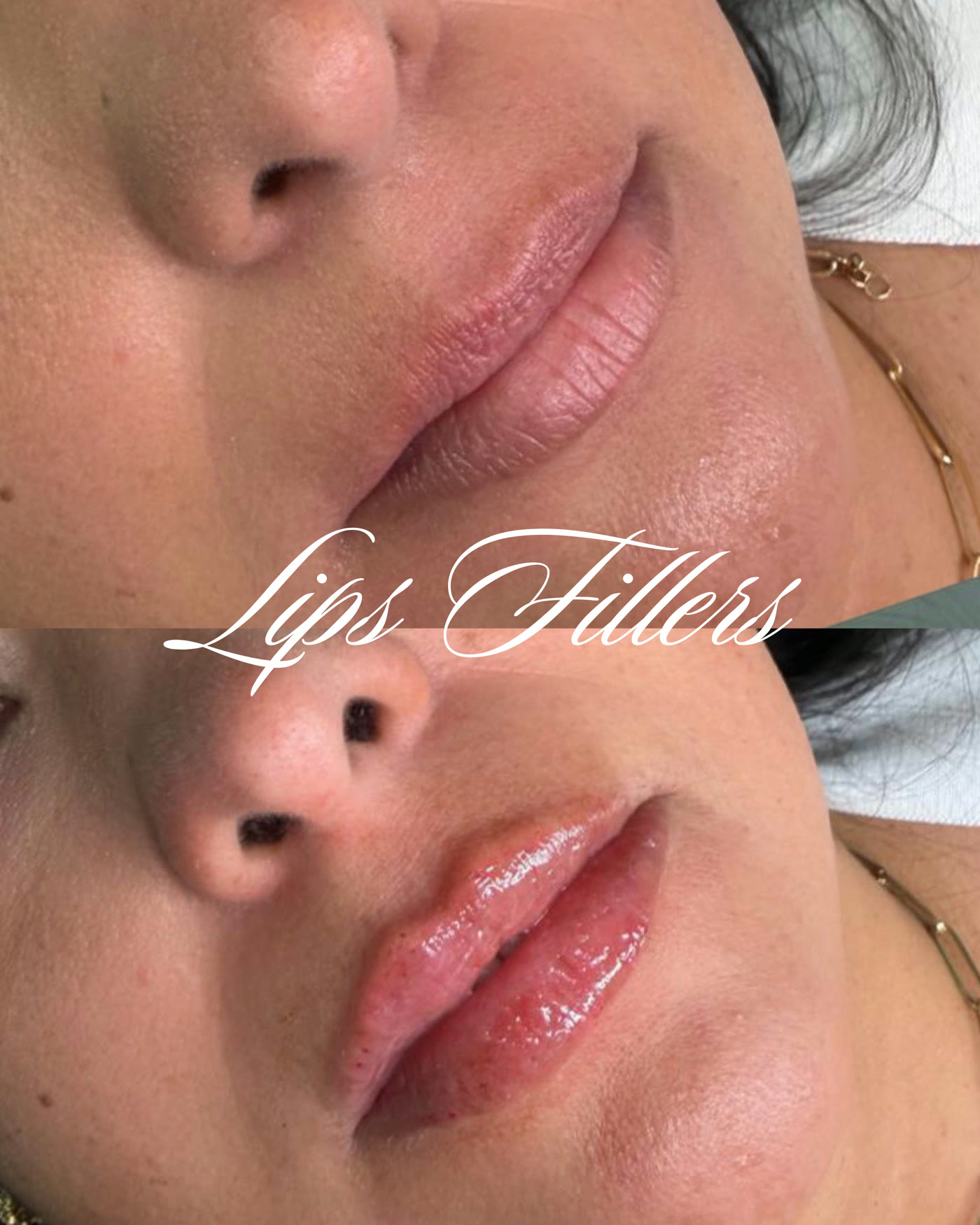 Rellenos de labios — antes y después