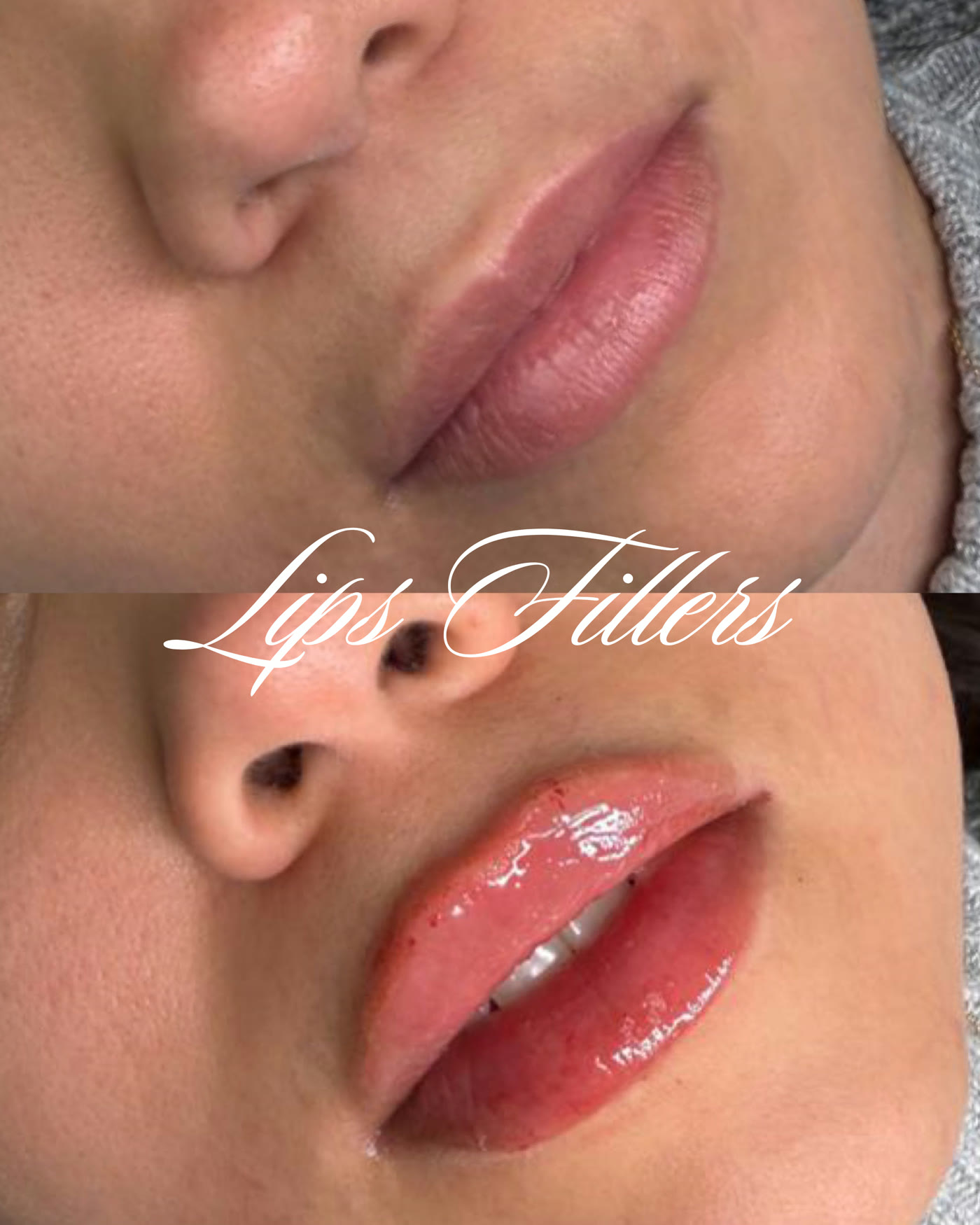 Rellenos de labios — antes y después