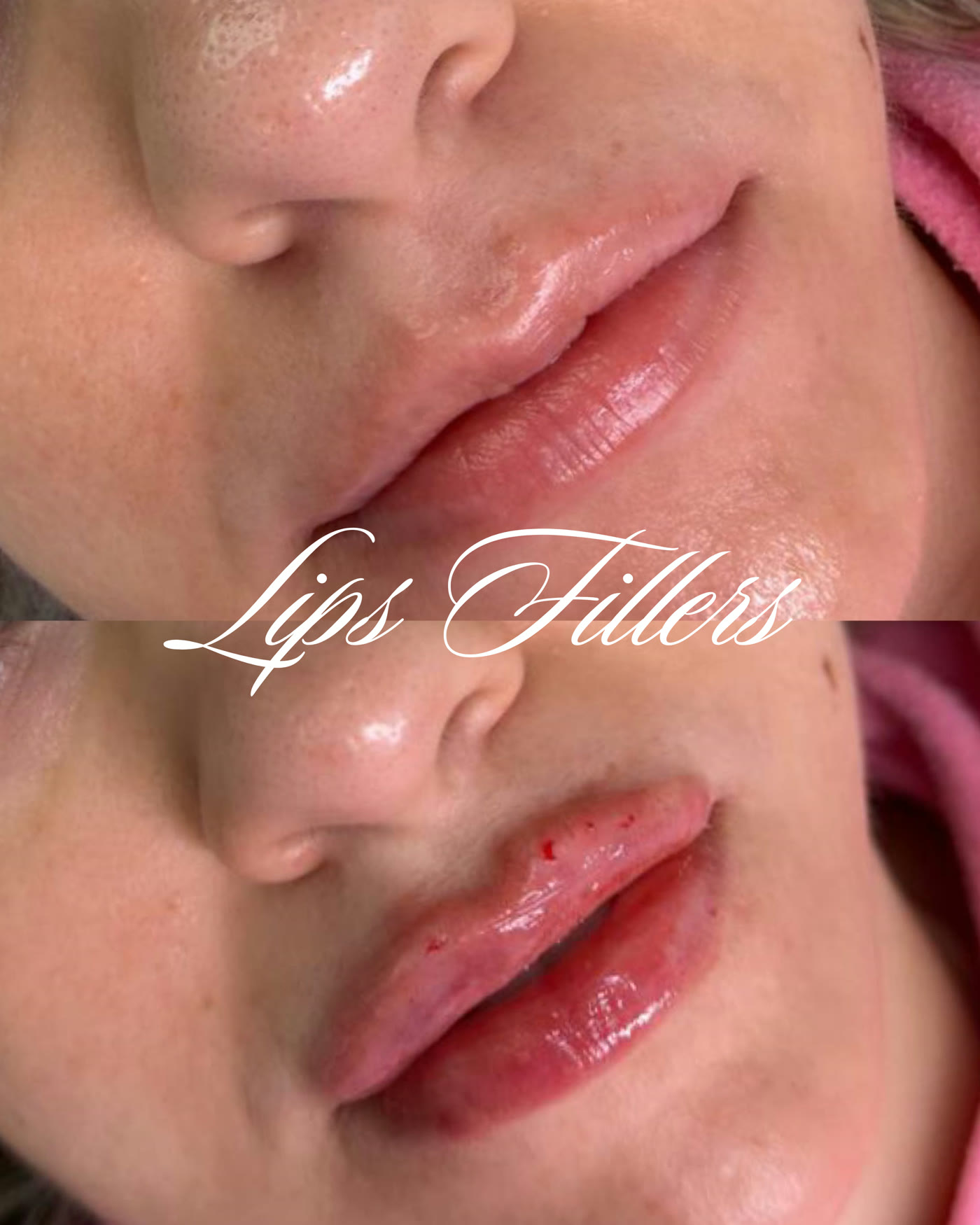 Rellenos de labios — antes y después