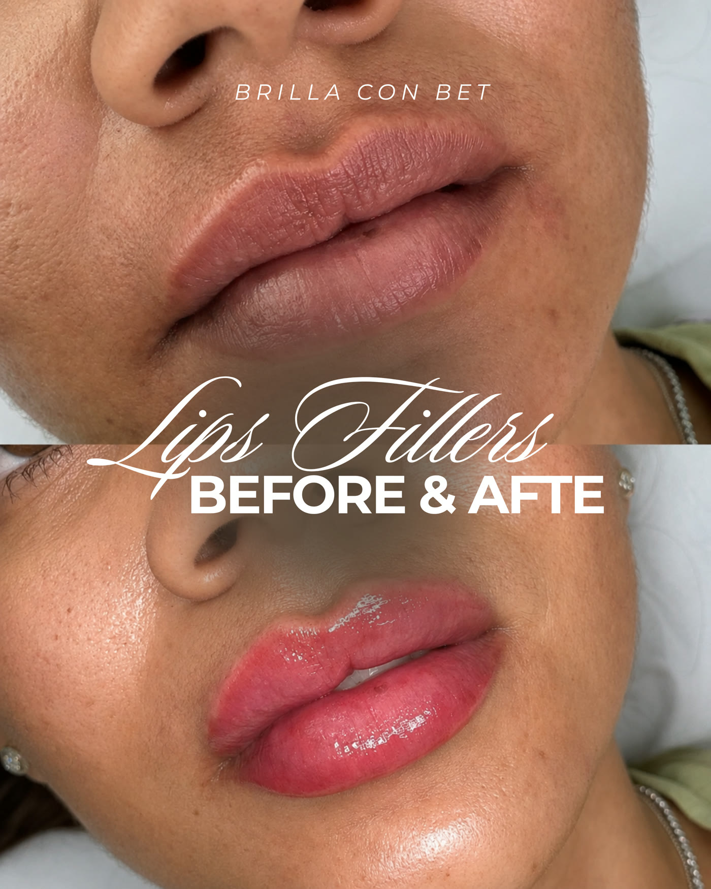 Rellenos de labios — antes y después