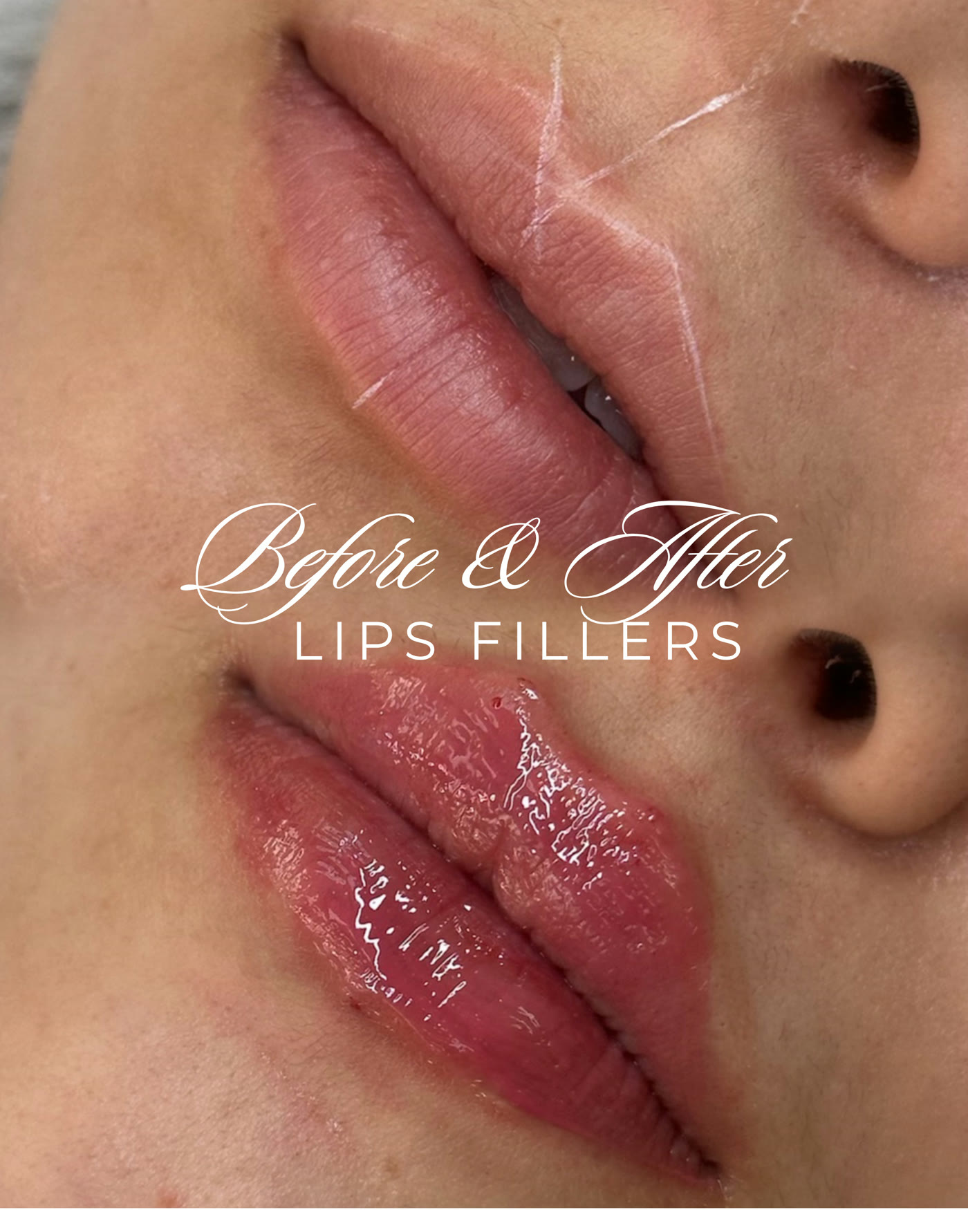Rellenos de labios — antes y después