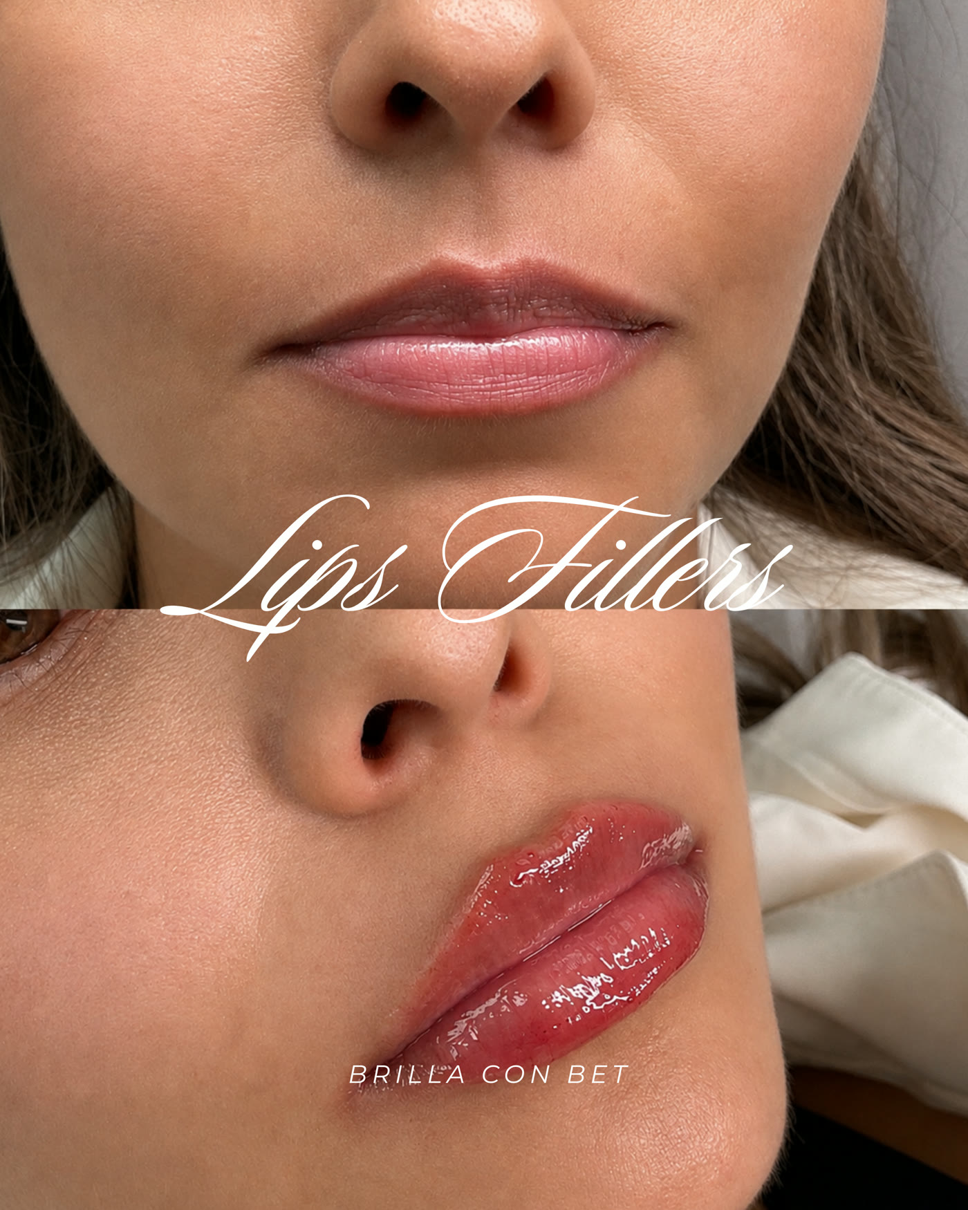 Rellenos de labios — antes y después