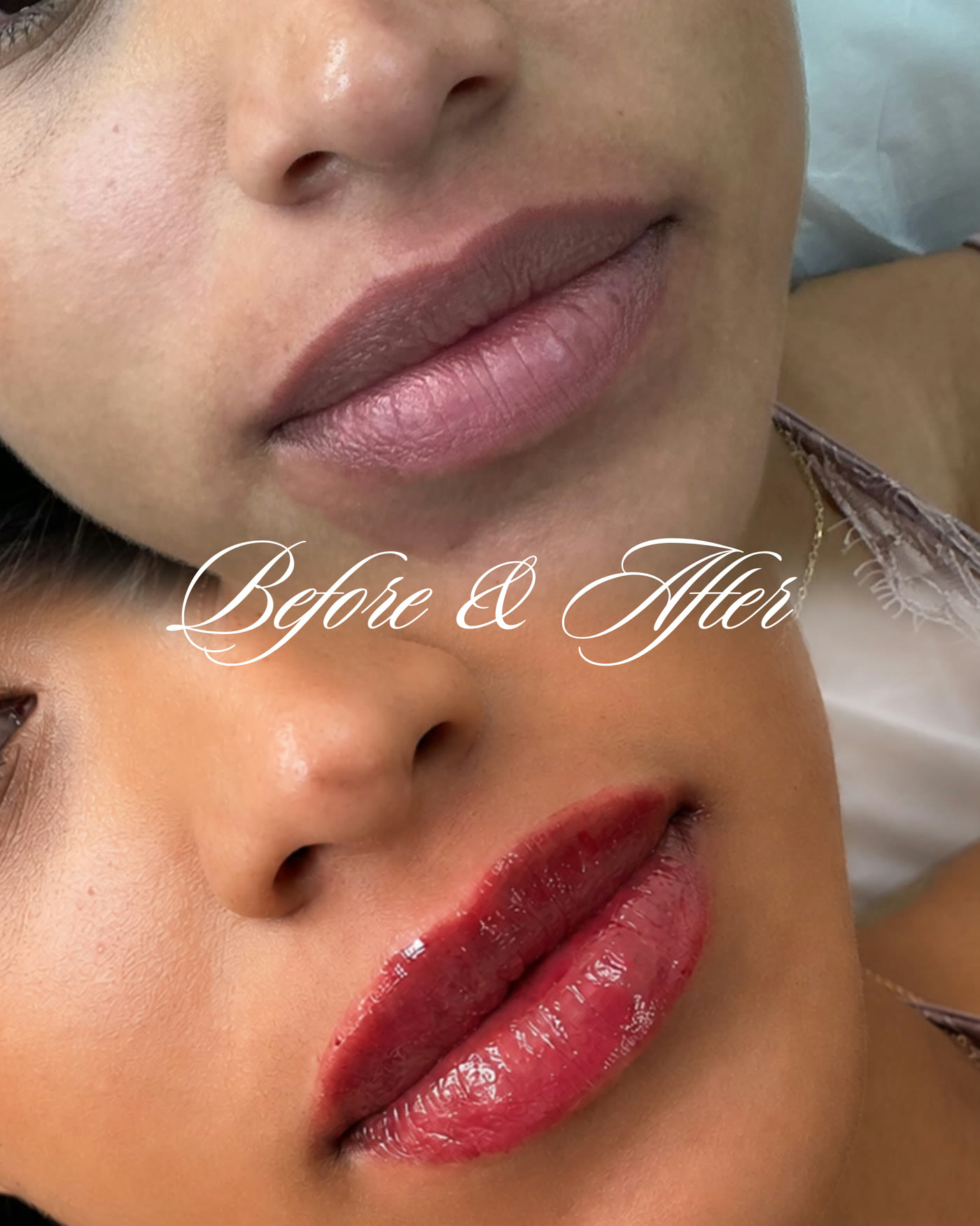 Rellenos de labios — antes y después