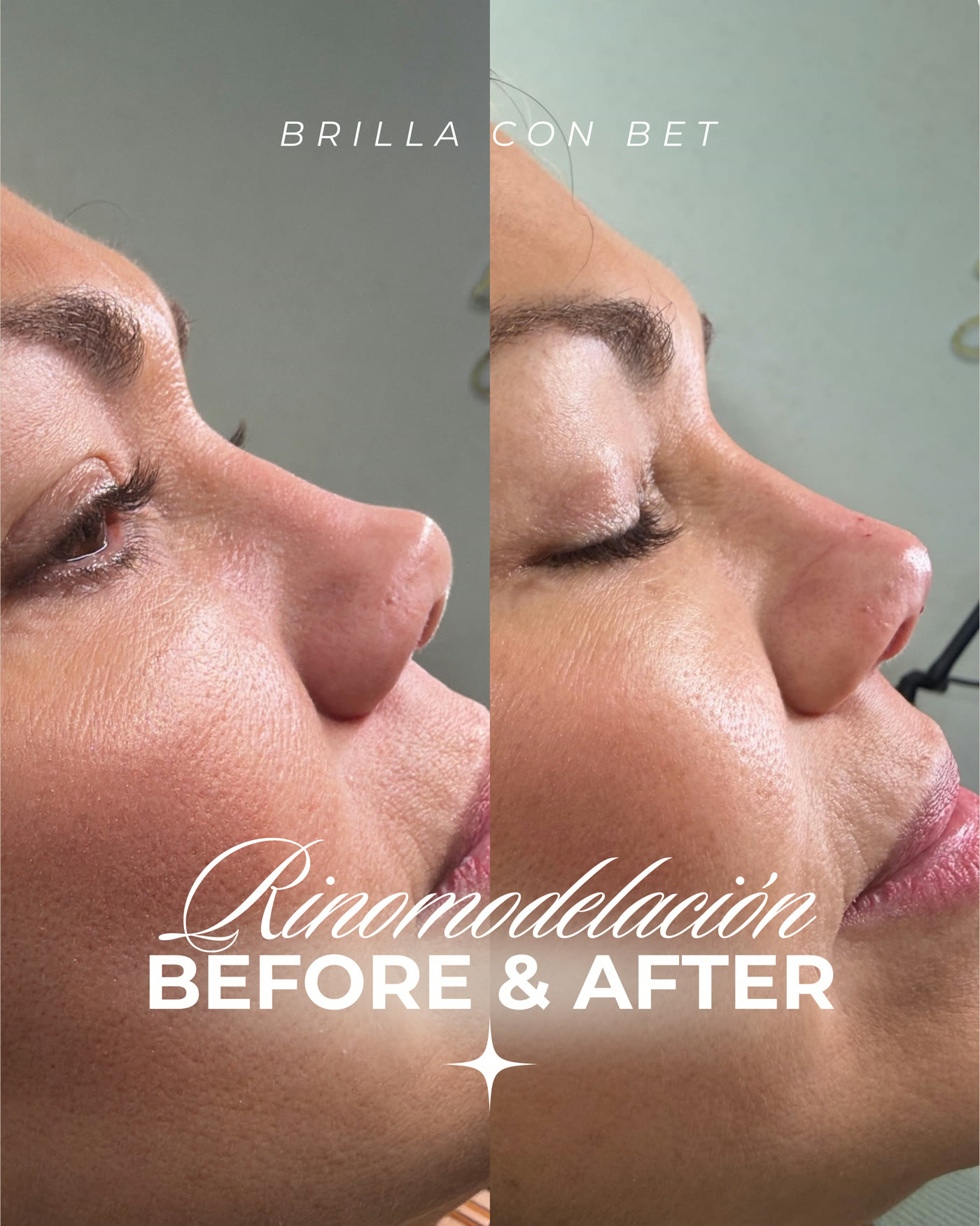 Rinomodelación con fillers — antes y después