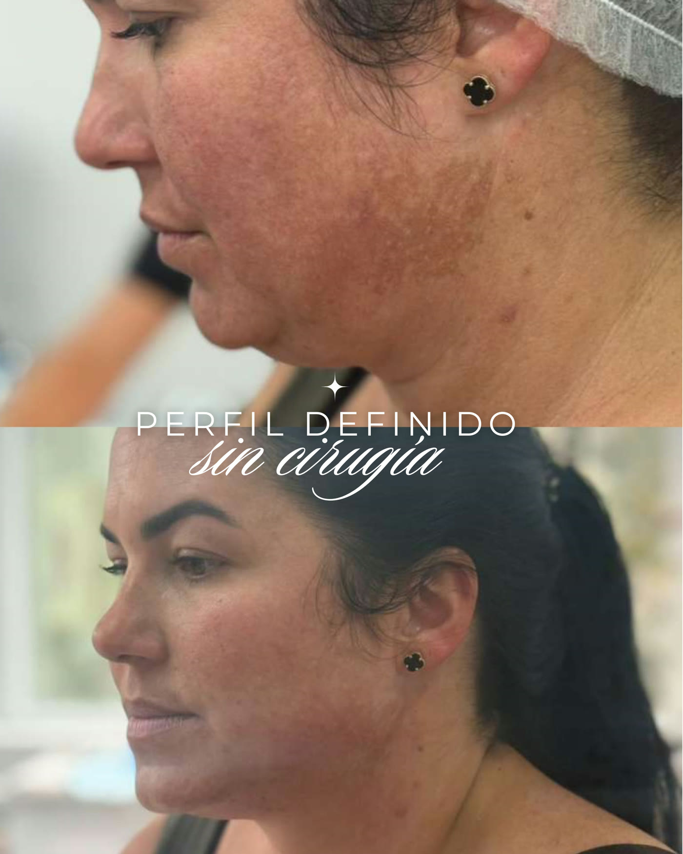 Endolifting — antes y después