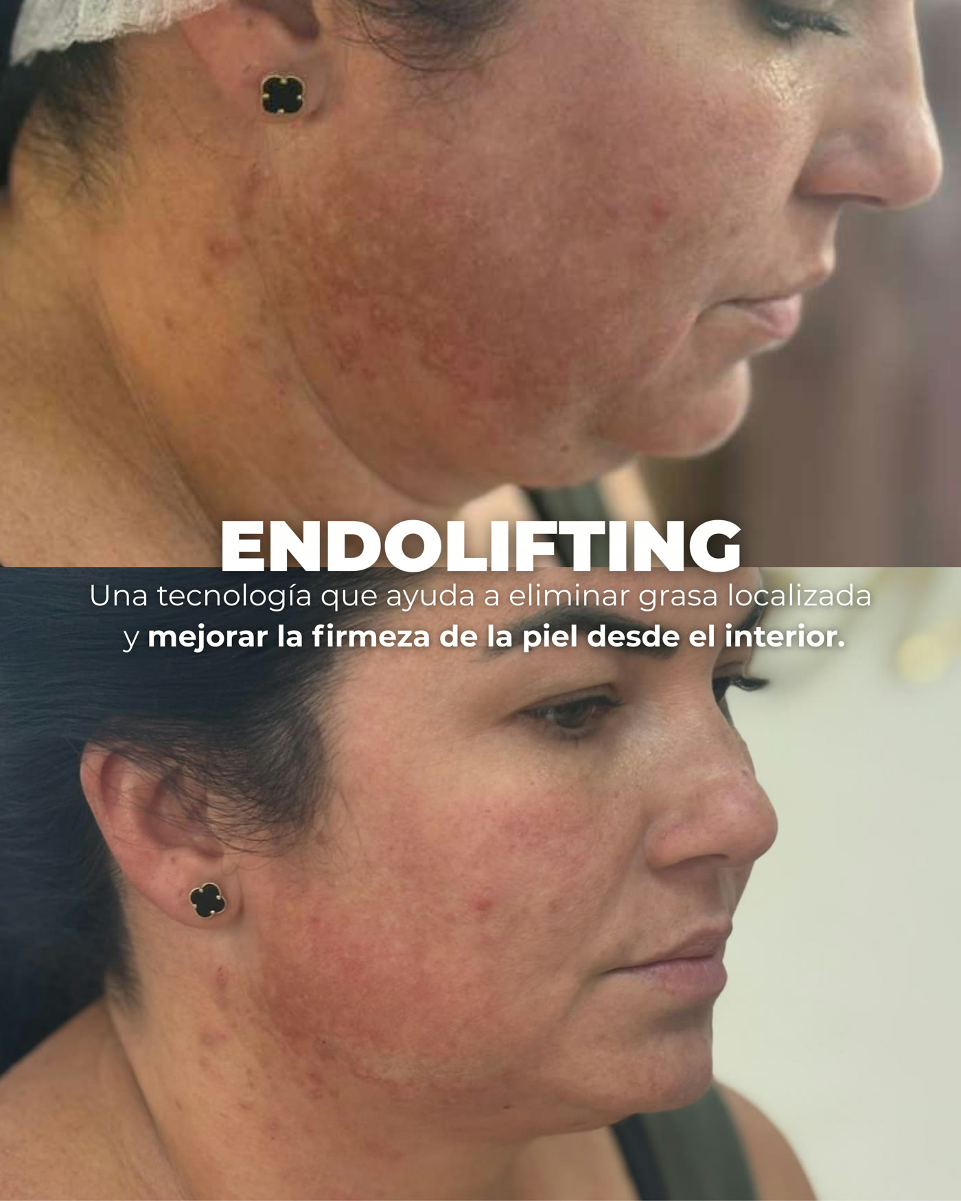 Endolifting — antes y después